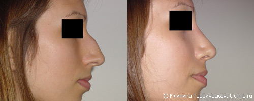 Ринопластика по уменьшению выраженности горбинки носа